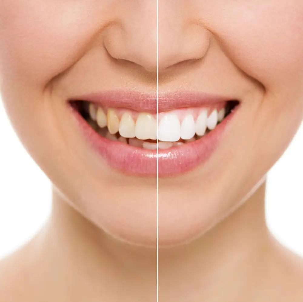 Before and After photo of Teeth Whitening with Cronin Dental , Cork