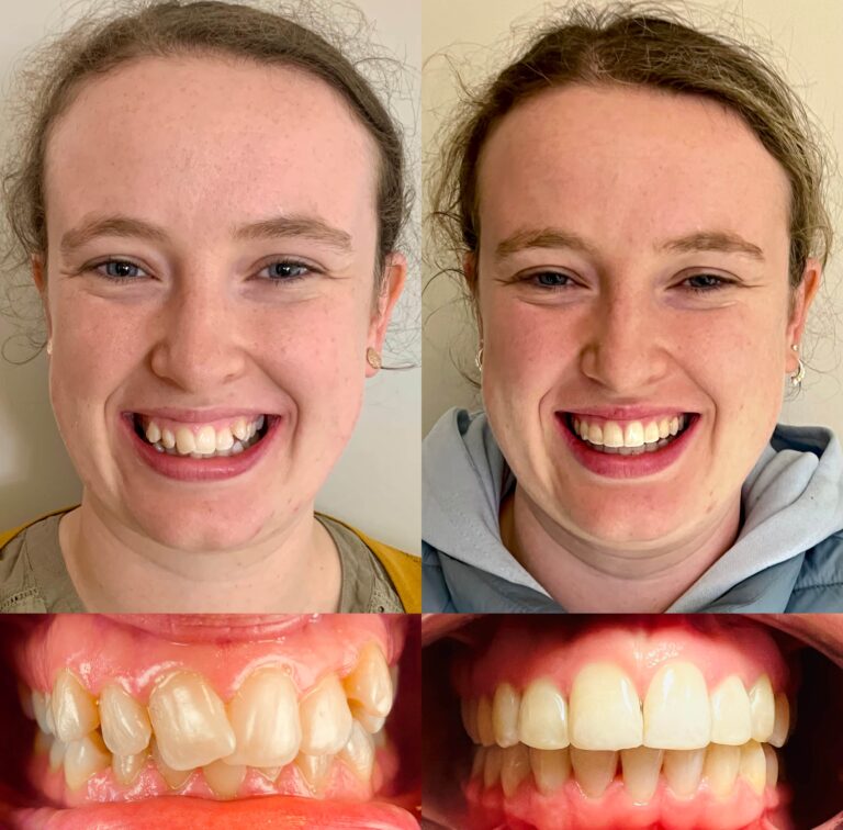 A young girl after treatment with Invisalign clear braces