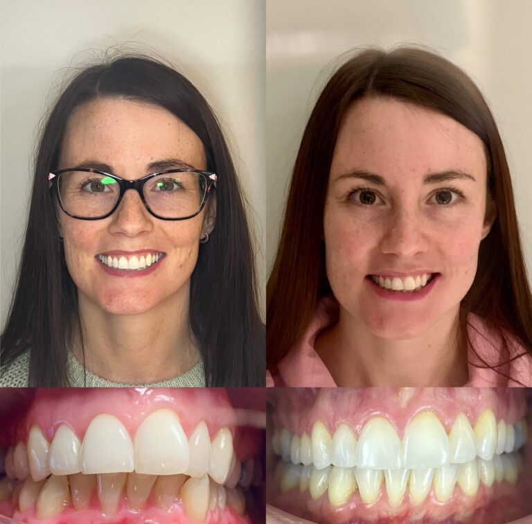 A young woman showing results of treatment with Invisalign clear braces