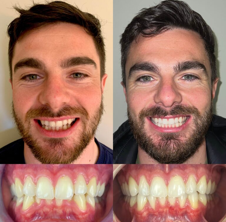 before and after photo of man showing the benefits of Invisalign Clear Braces