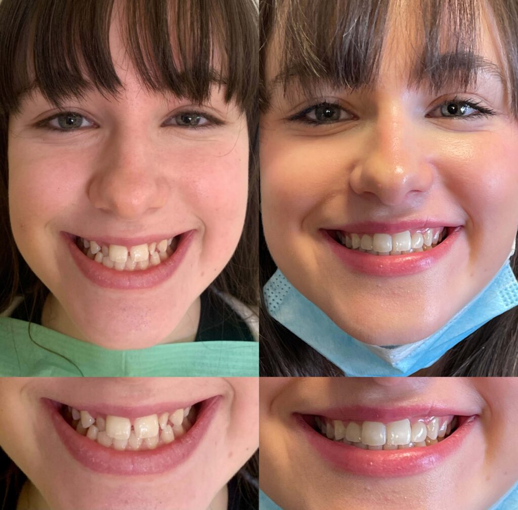 Before and After photo of teenager showing benefit of treatment with Invisalign Clear braces