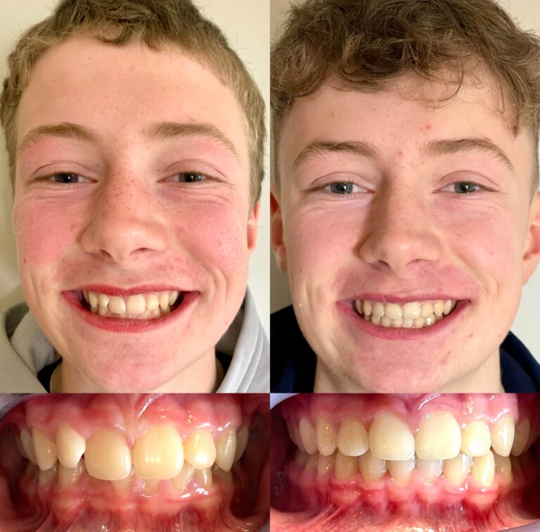 Before and After photos side by side of teenager showing benefit of Invisalign Clear braces treatment