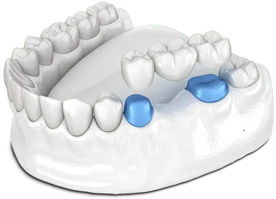 Dental Bridge Model Cronin Dental Cork