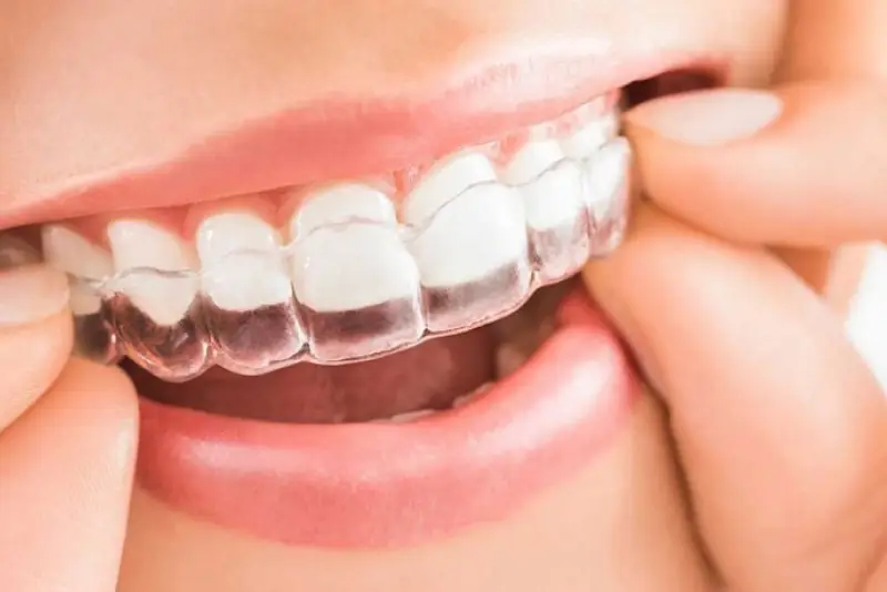 Mouth of patient with Invisalign Clear Braces at Cronin Dental, Cork