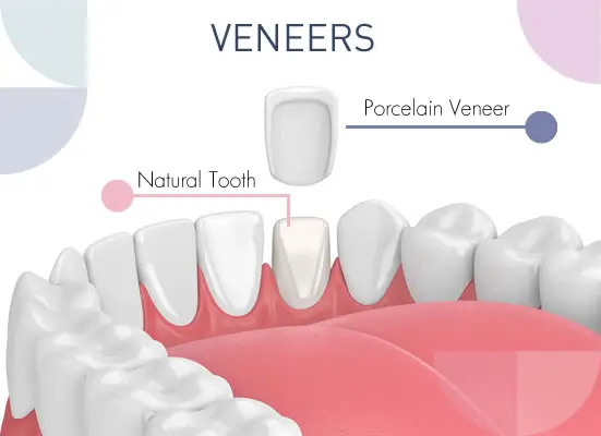 Veneers at Cronin Dental Cork