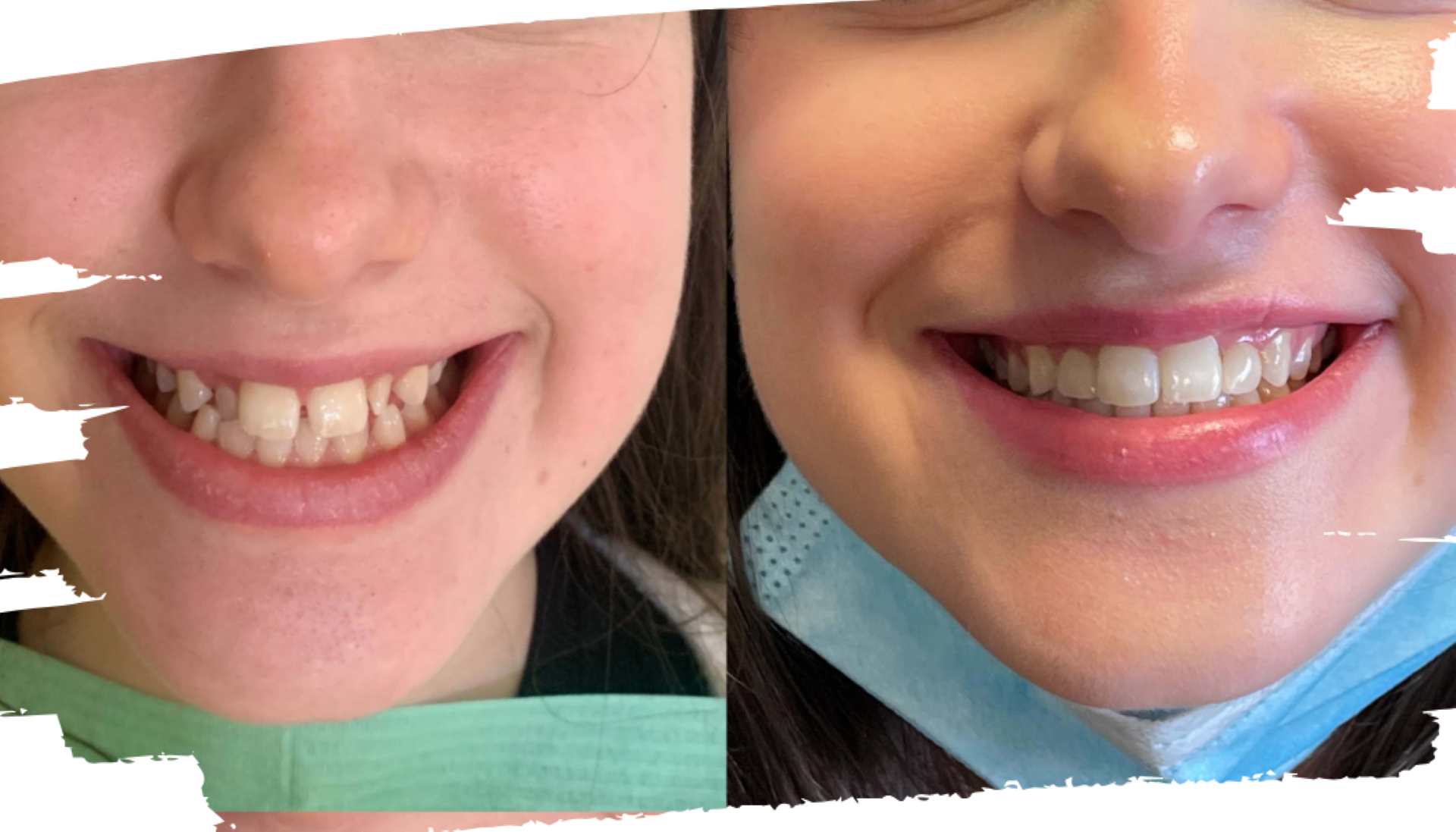 Girl Invisalign Braces Before and After