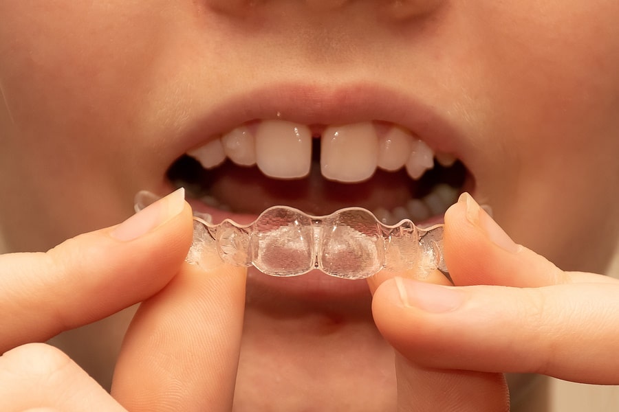 Invisalign Braces for teens in Cork