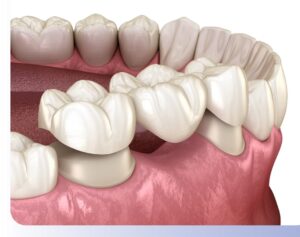 Dental Bridge